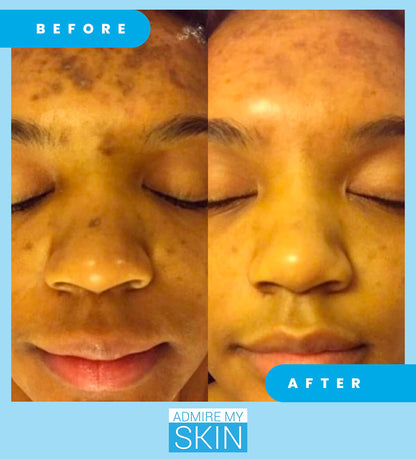 Admire My Skin Dark Spot Corrector Remover for Face - Brightening Discoloration Correcting Serum - Kojic Acid + Azelaic Acid Serum for Melasma and Sun Spots 1oz